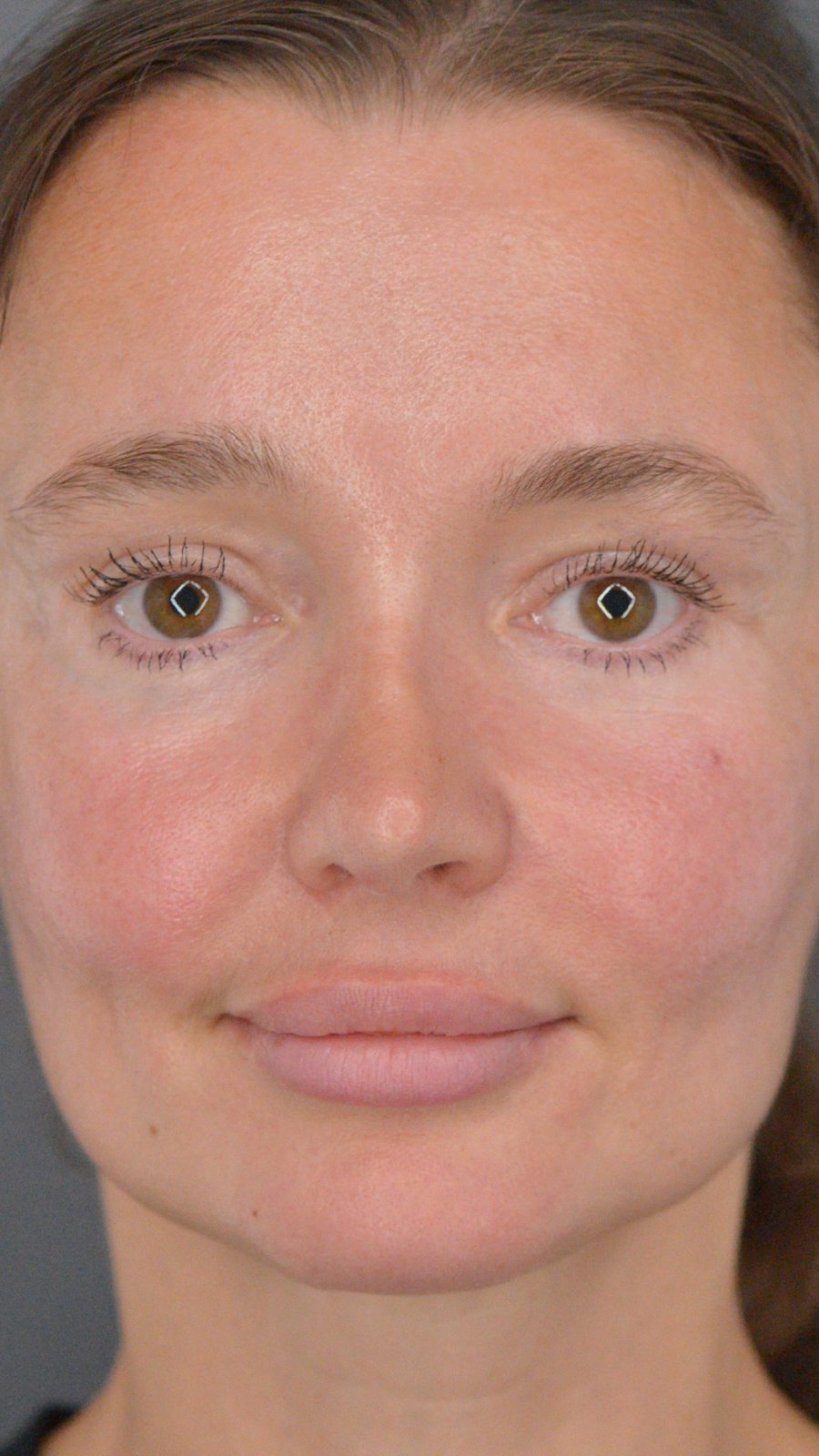 Rhinoplasty after, case 02