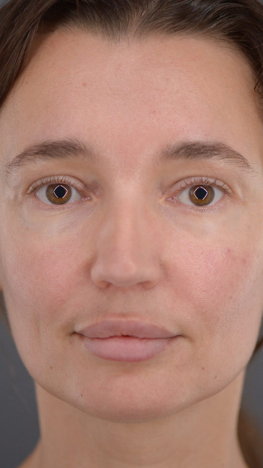 Rhinoplasty before, case 02