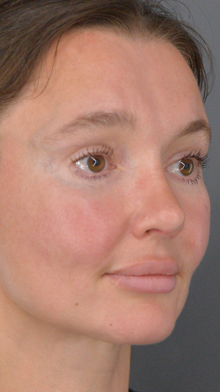 Rhinoplasty before and after, case 02, view 3 (after)