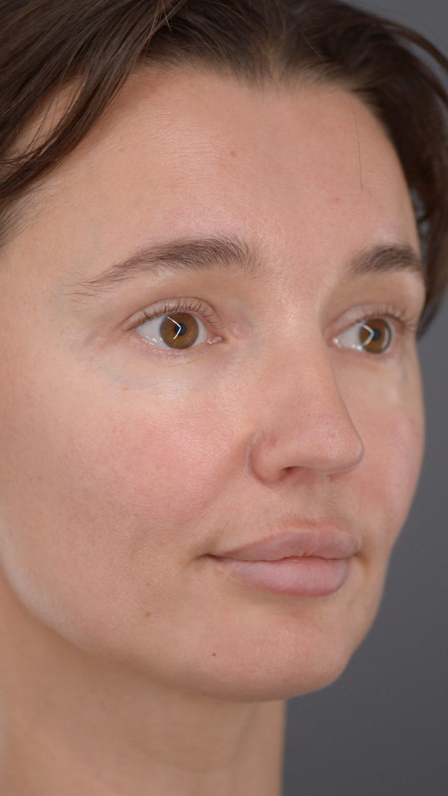 Rhinoplasty before and after, case 02, view 3 (before)
