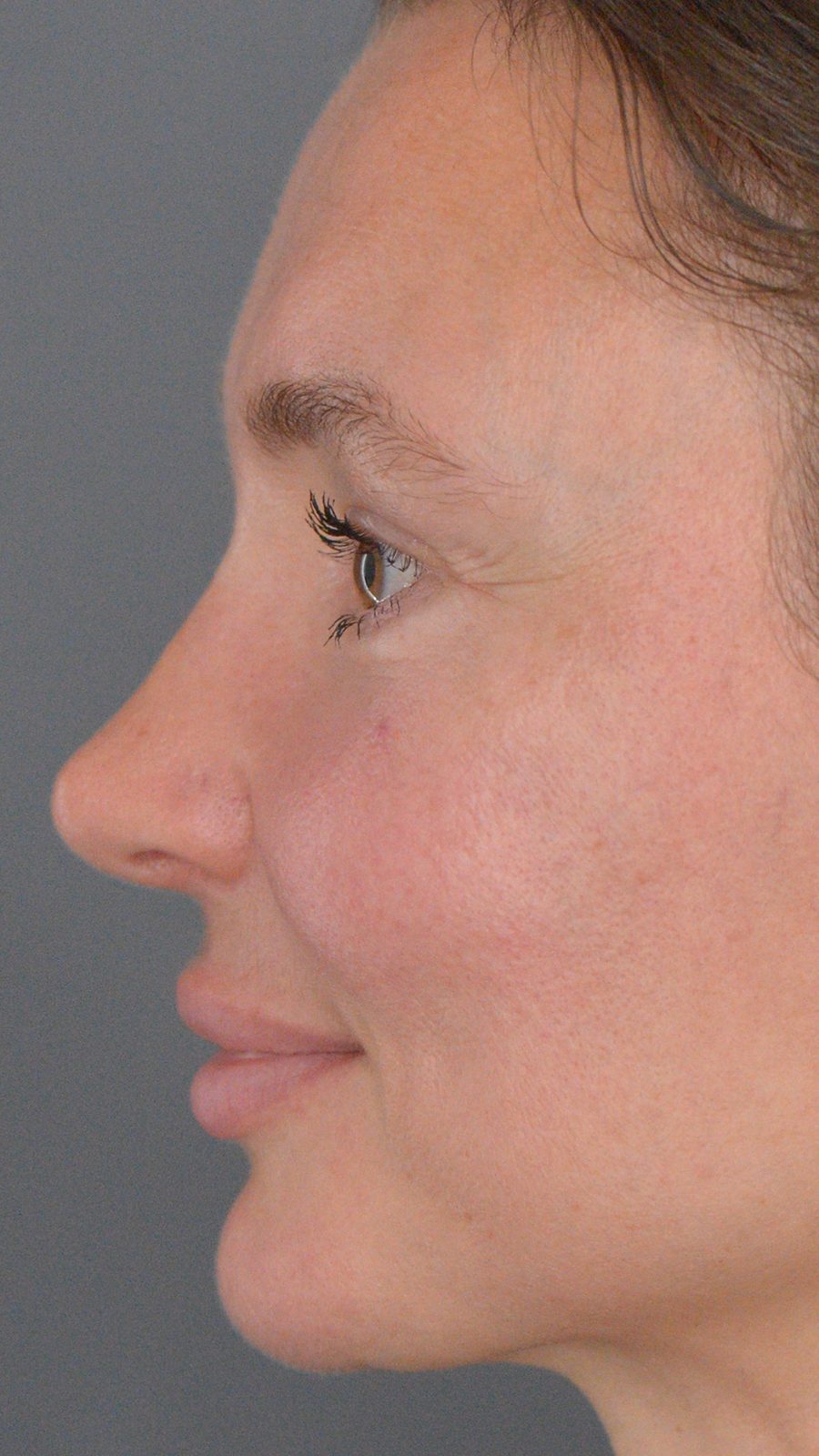 Rhinoplasty before and after, case 02, view 4 (after)