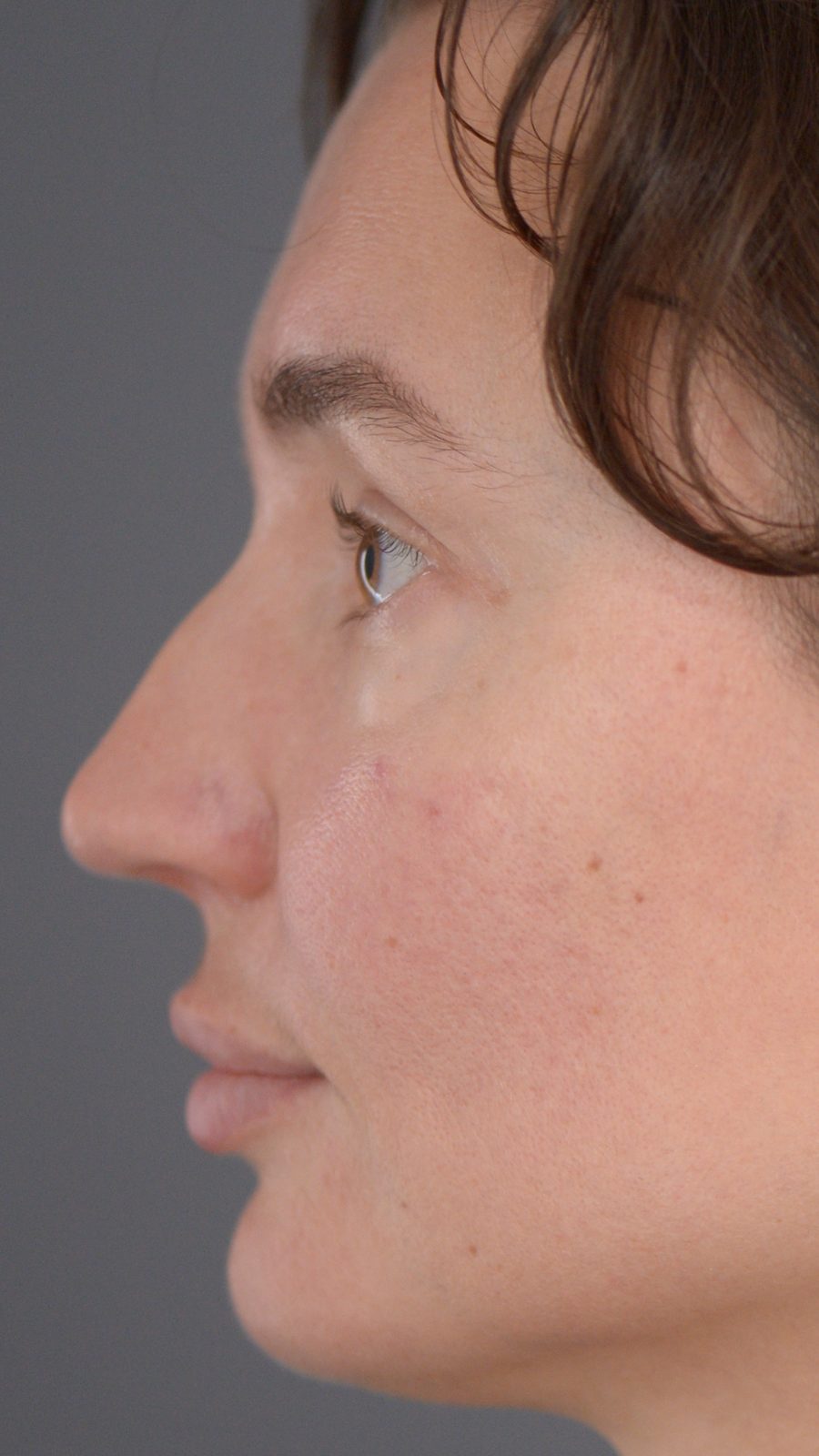 Rhinoplasty before and after, case 02, view 4 (before)