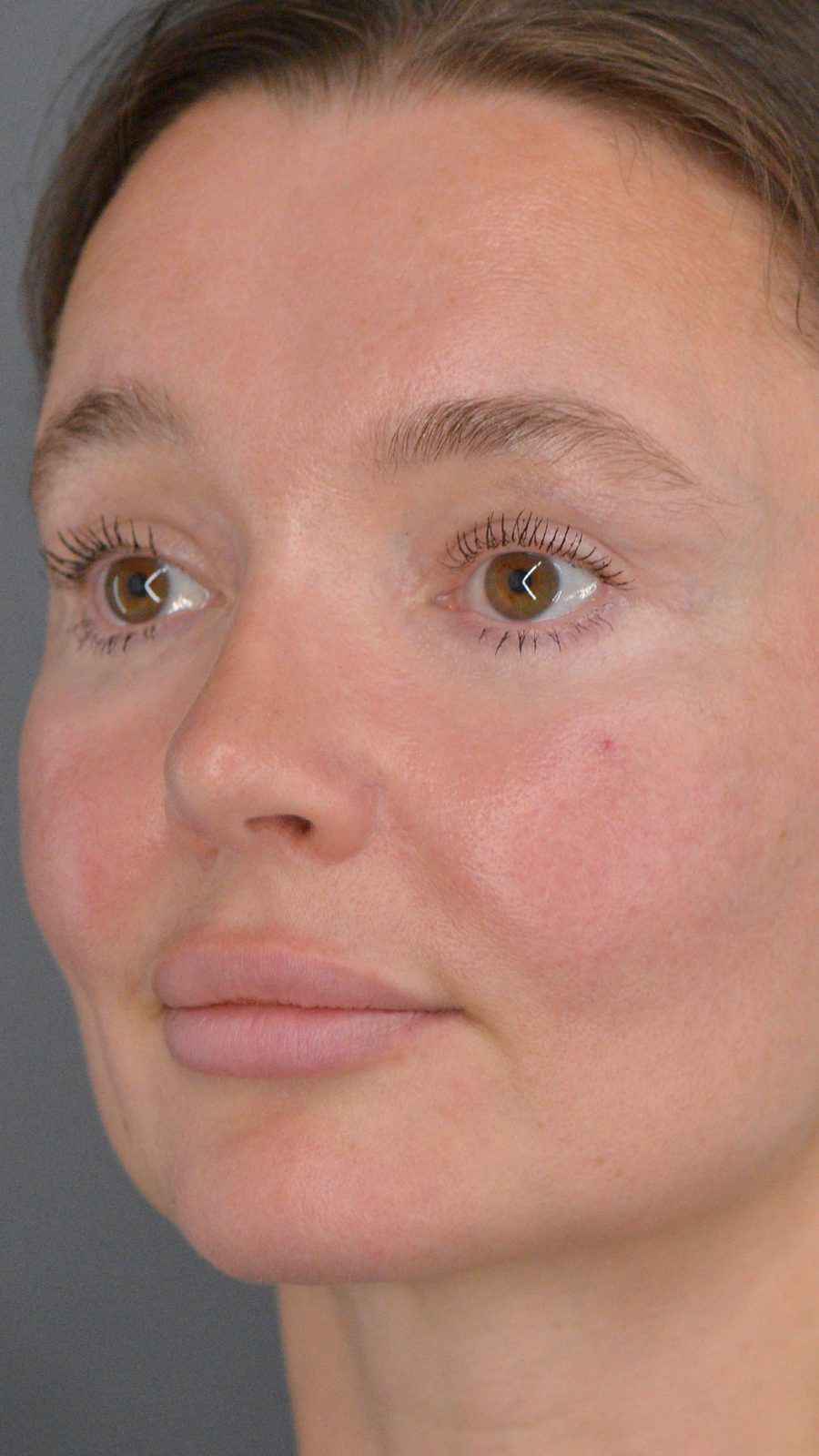 Rhinoplasty before and after, case 02, view 5 (after)