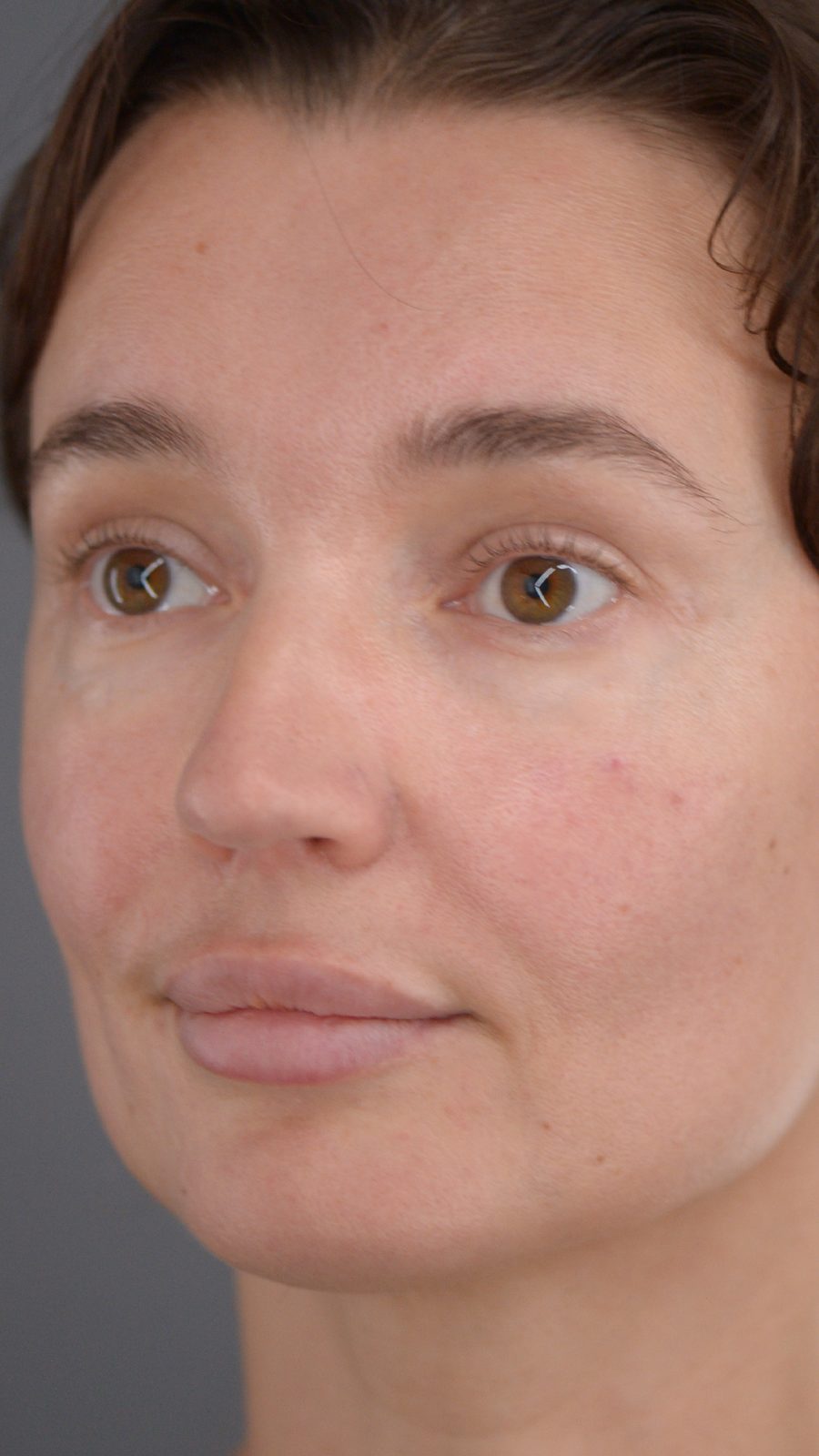 Rhinoplasty before and after, case 02, view 5 (before)