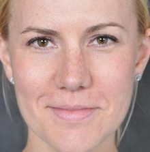 Rhinoplasty before and after, case 03 (after)