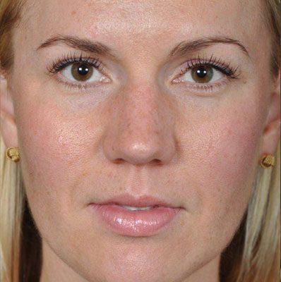 Rhinoplasty before, case 03