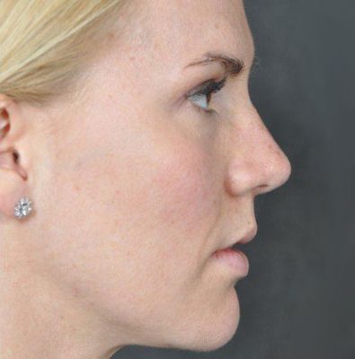 Rhinoplasty before and after, case 03, view 3 (after)