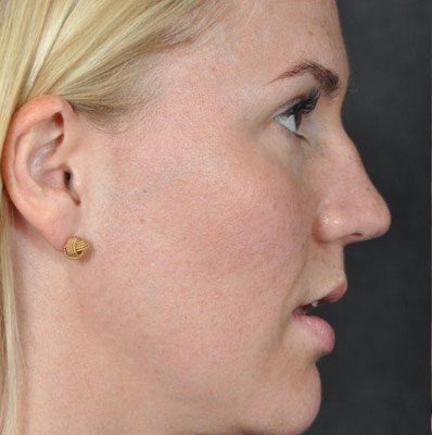 Rhinoplasty before and after, case 03, view 3 (before)