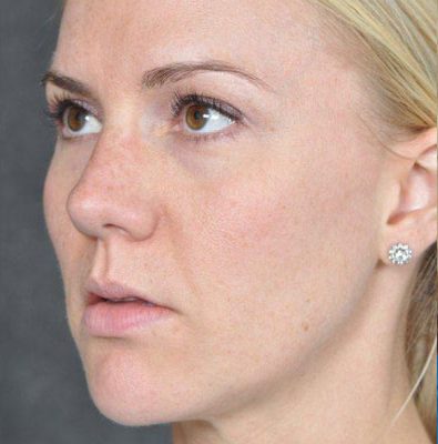 Rhinoplasty before and after, case 03, view 4 (after)