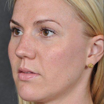 Rhinoplasty before and after, case 03, view 4 (before)