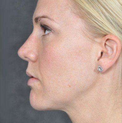 Rhinoplasty before and after, case 03, view 5 (after)