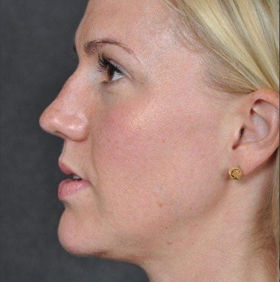 Rhinoplasty before and after, case 03, view 5 (before)