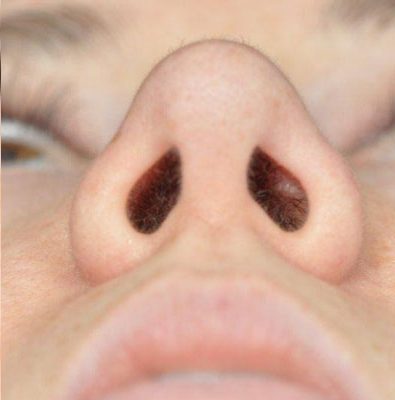 Rhinoplasty before and after, case 03, view 6 (after)