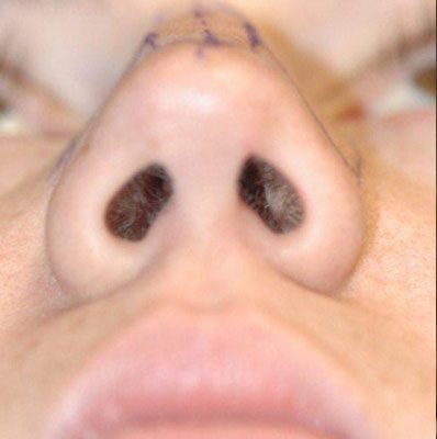 Rhinoplasty before and after, case 03, view 6 (before)