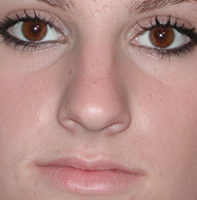 Rhinoplasty after, case 04