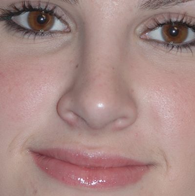 Rhinoplasty before, case 04