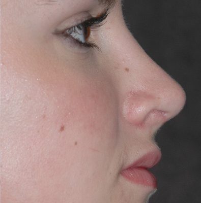Rhinoplasty before and after, case 04, view 3 (after)