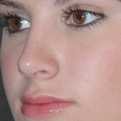 Rhinoplasty before and after, case 04, view 4 (after)