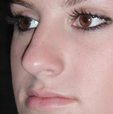 Rhinoplasty before and after, case 04, view 4 (before)