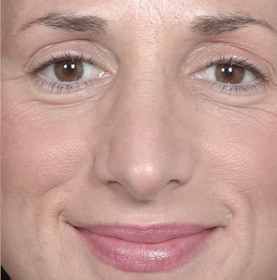 Rhinoplasty after, case 05