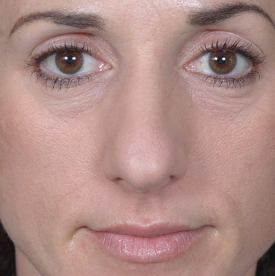 Rhinoplasty before, case 05