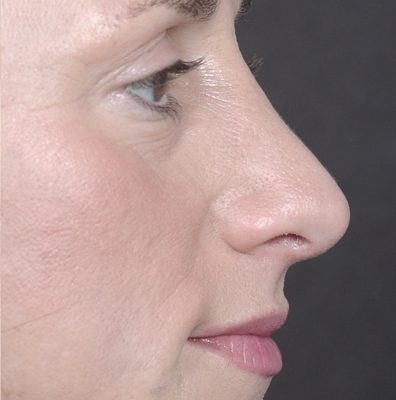 Rhinoplasty before and after, case 05, view 3 (after)