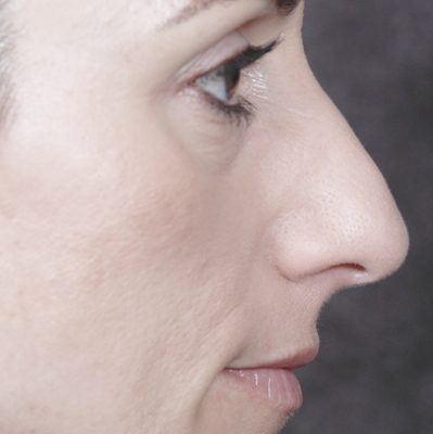Rhinoplasty before and after, case 05, view 3 (before)