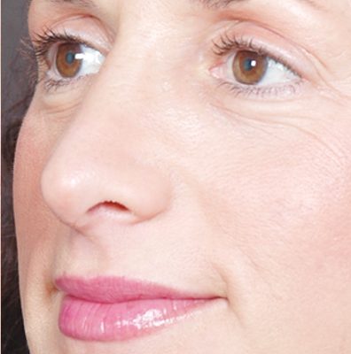 Rhinoplasty before and after, case 05, view 4 (after)