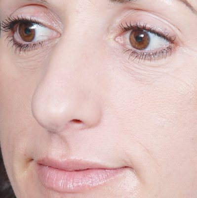 Rhinoplasty before and after, case 05, view 4 (before)
