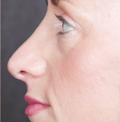 Rhinoplasty before and after, case 05, view 5 (after)