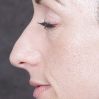 Rhinoplasty before and after, case 05, view 5 (before)