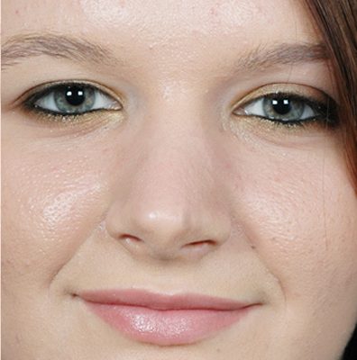 Rhinoplasty after, case 06