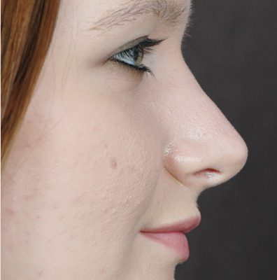 Rhinoplasty before and after, case 06, view 3 (after)