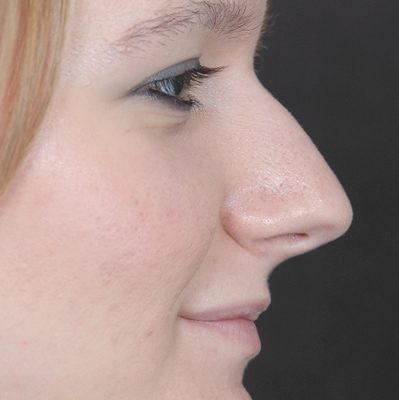 Rhinoplasty before and after, case 06, view 3 (before)