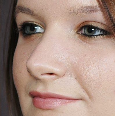 Rhinoplasty before and after, case 06, view 4 (after)