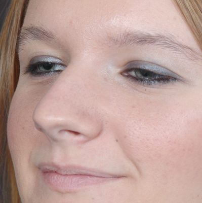 Rhinoplasty before and after, case 06, view 4 (before)
