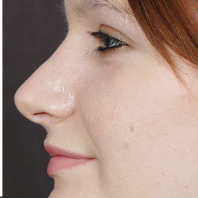 Rhinoplasty before and after, case 06, view 5 (after)