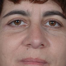 Rhinoplasty before and after, case 07 (before)