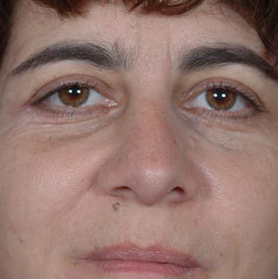 Rhinoplasty before, case 07