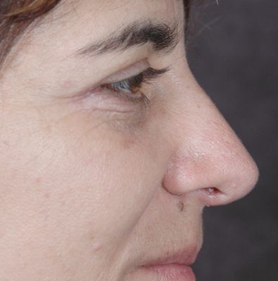 Rhinoplasty before and after, case 07, view 3 (after)
