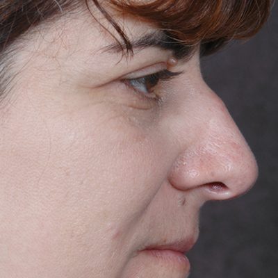 Rhinoplasty before and after, case 07, view 3 (before)