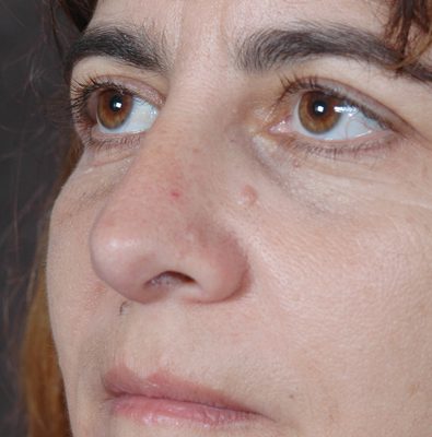 Rhinoplasty before and after, case 07, view 4 (after)