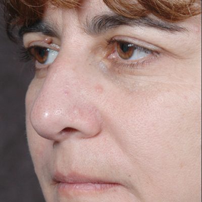 Rhinoplasty before and after, case 07, view 4 (before)