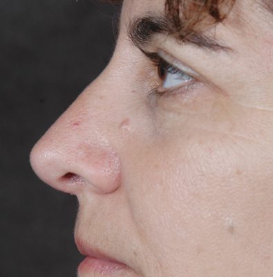Rhinoplasty before and after, case 07, view 5 (after)