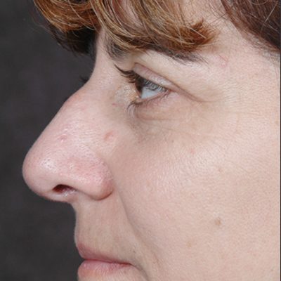 Rhinoplasty before and after, case 07, view 5 (before)