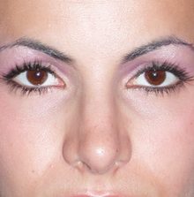 Rhinoplasty before and after, case 08 (after)