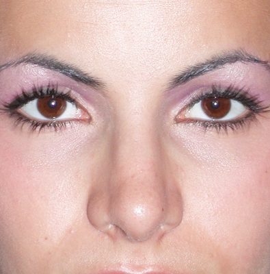Rhinoplasty after, case 08