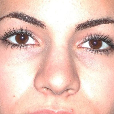 Rhinoplasty before, case 08