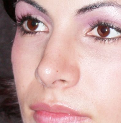 Rhinoplasty before and after, case 08, view 3 (after)