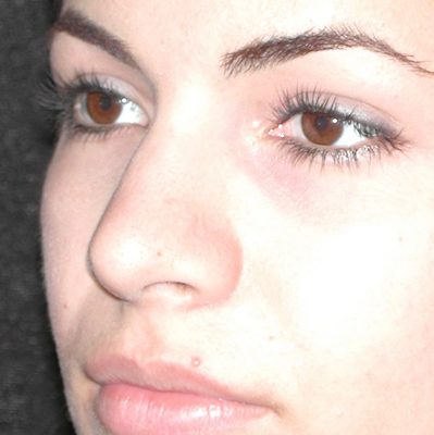 Rhinoplasty before and after, case 08, view 3 (before)